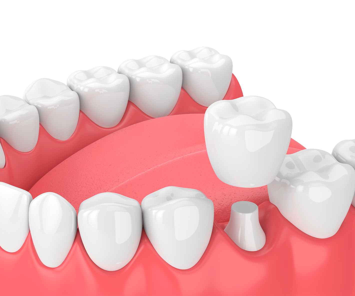Зуби з цирконію: якість та краса усмішки
