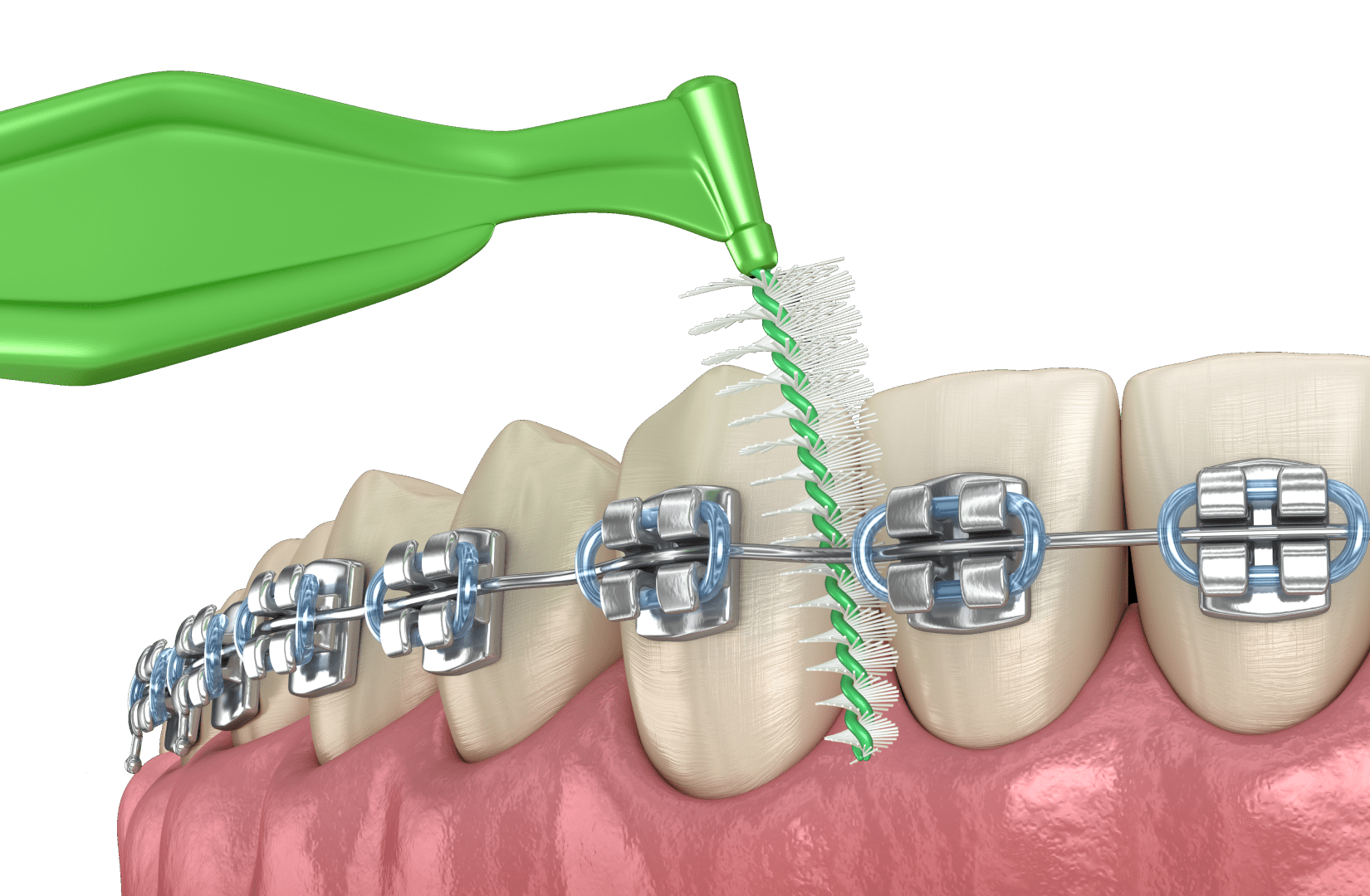 Прозорі брекети: інноваційний підхід до виправлення зубів