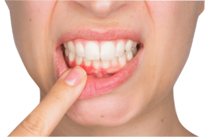 Пародонтит - серйозне захворювання, що впливає на якість життя та стан зубів. У Києві, клініка SIY Dental надає допомогу у боротьбі з цим захворюванням.